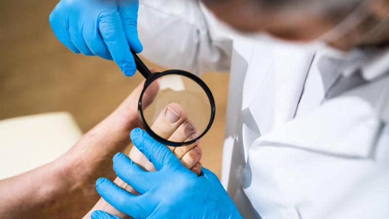 درمان قارچ ناخن